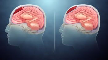 3D Medical Animation still types of Intracranial hematoma: Subdural hematoma(L) and Epidural hematoma(R).