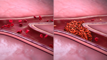 3D medical animation still showing normal RBCs(L) and abnormal, sickled RBCs(R)