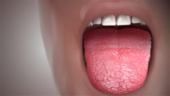 3D medical animation still showing decreased or insufficient functioning of salivary glands.