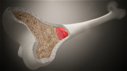 3D Medical Animation still of Bone marrow