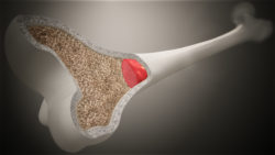 3D medical animation still of Bone marrow