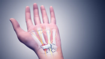 3D medical animation still of Carpal Tunnel Syndrome