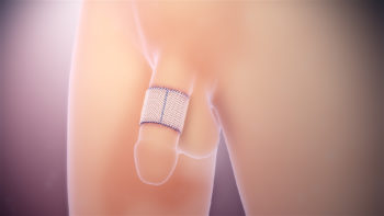 3D medical animation still showing skin grafting in case of Penile injury.