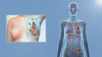 3D medical animation still showing metastatic or stage 4 Breast Cancer