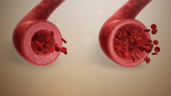 3D Medical animation still showing Normal blood vessel(L) Vs. Vasodilation(R)