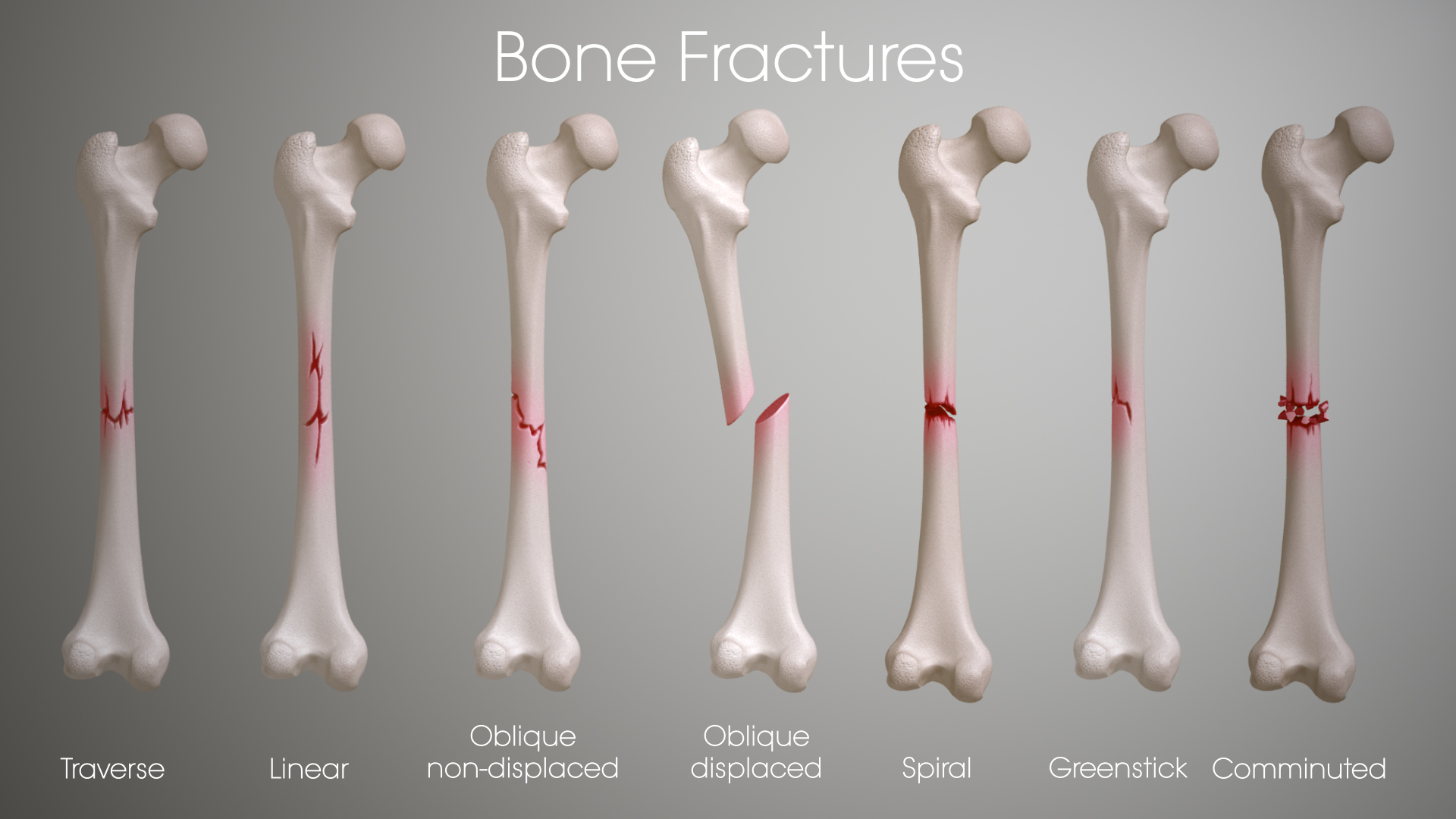 Fractures: Types, Symptoms, Causes and Treatment - Scientific Animations