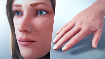 3D medical animation still showing flat warts.