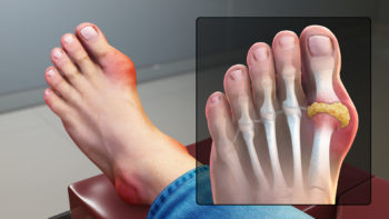 3D medical animation still showing gout infected foot.