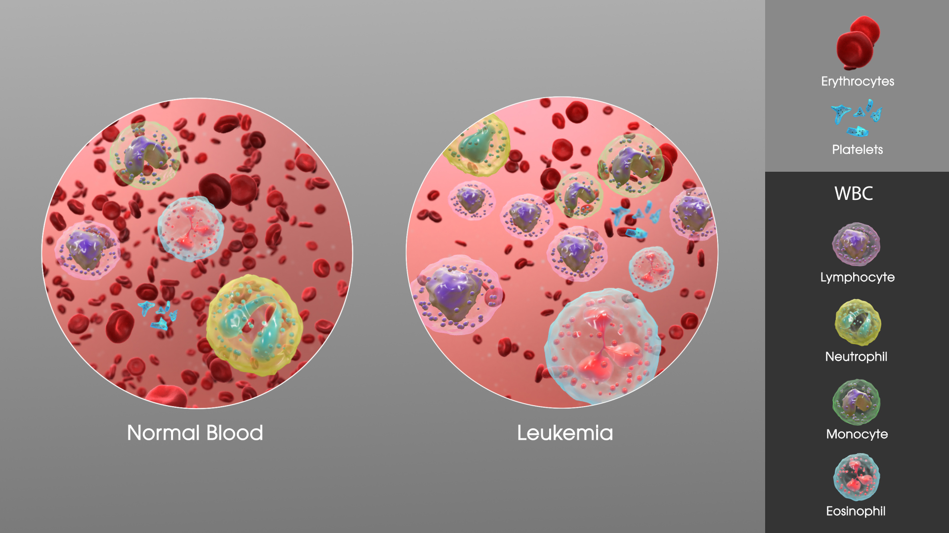 3D Medical Animation still showing comparison between Normal blood and Leukemia