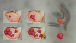 3D medical animation still of Prostate Cancer Stages