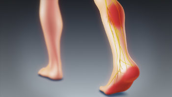 3D medical animation still showing Sciatica.