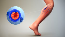 3D medical animation still showing Deep Vein Thrombosis