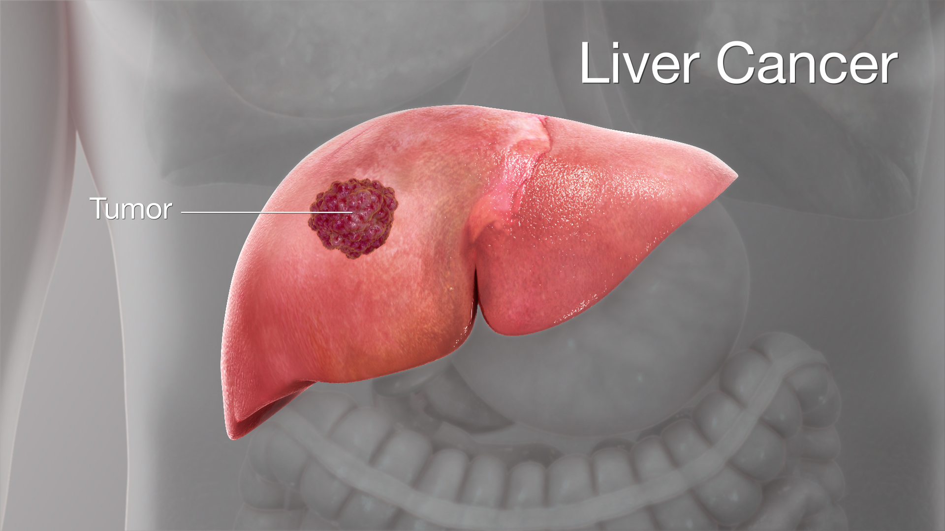 New Findings May Contribute to Better Diagnosis and Treatment of Liver Cancer