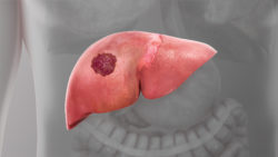 3D medical animation still showing Liver Cancer