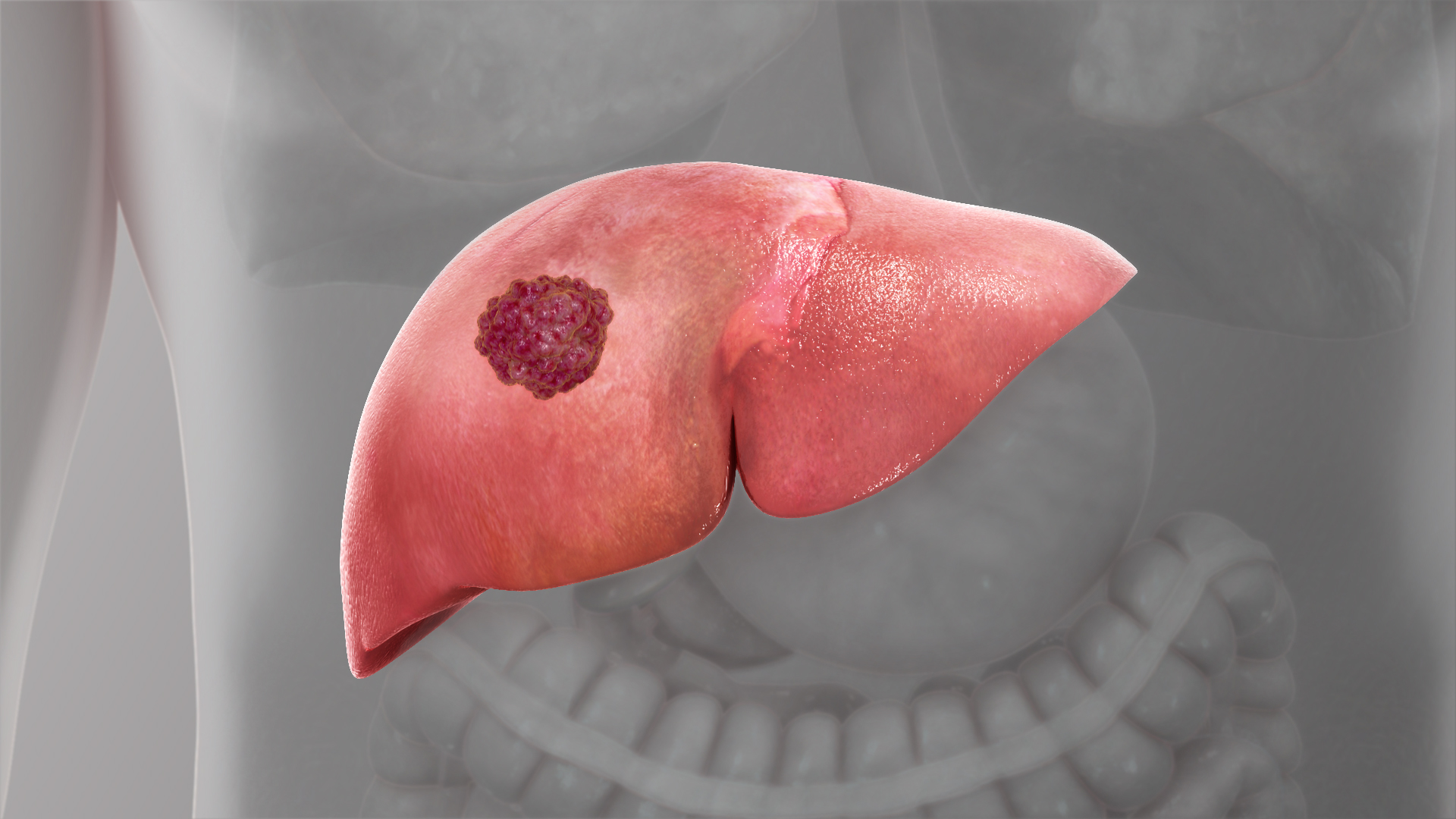 Liver cancer: Symptoms, Causes, and Treatment - Scientific Animations