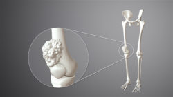 3D still showing Bone Cancer