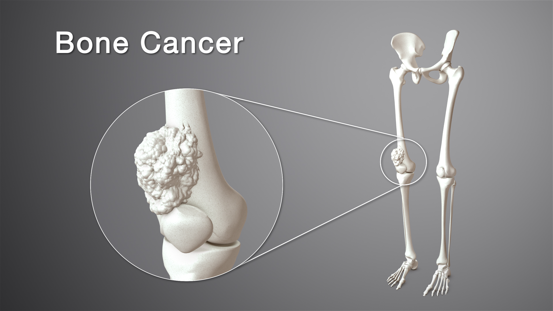 Bone Cancer: Types, Symptoms, Causes and Treatment - Scientific Animations