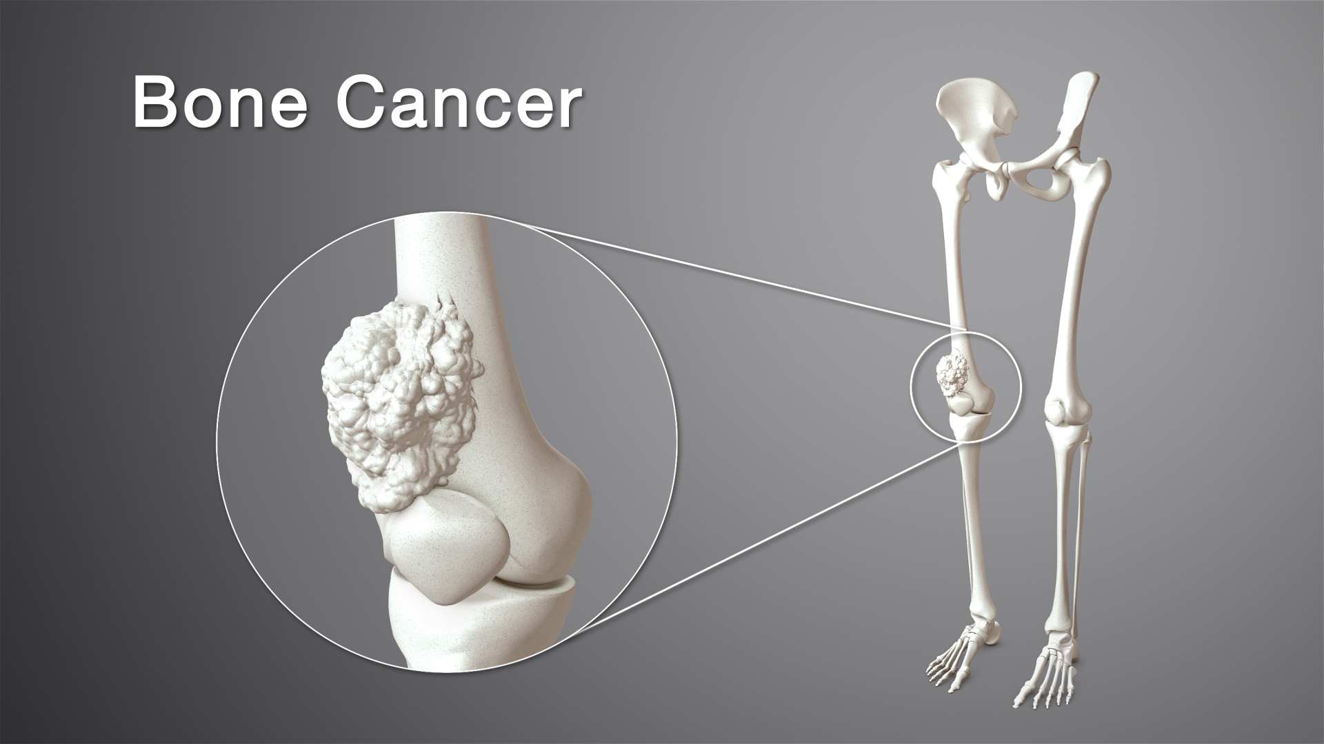 current research on bone cancer