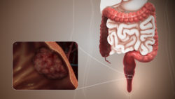 3D Medical Animation still showing Colorectal Cancer