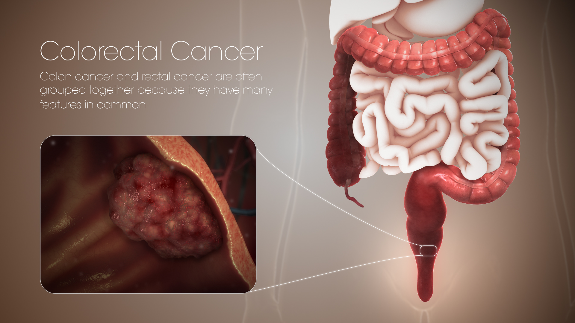 rectal cancer and colon cancer)