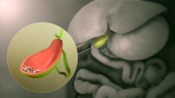 3D Medical animation still showing Gallstones.