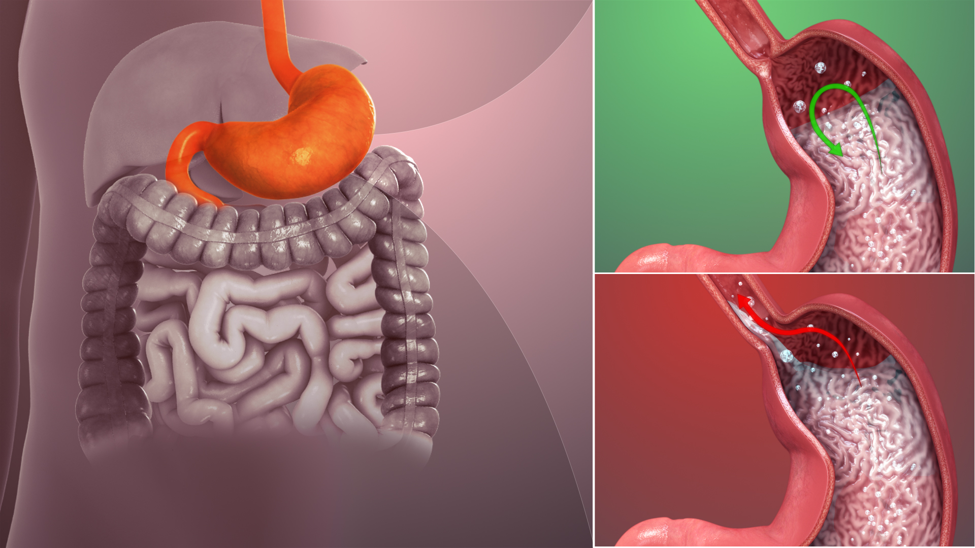 Gastroesophageal Reflux Disease GERD Symptoms Causes Risks Treatment