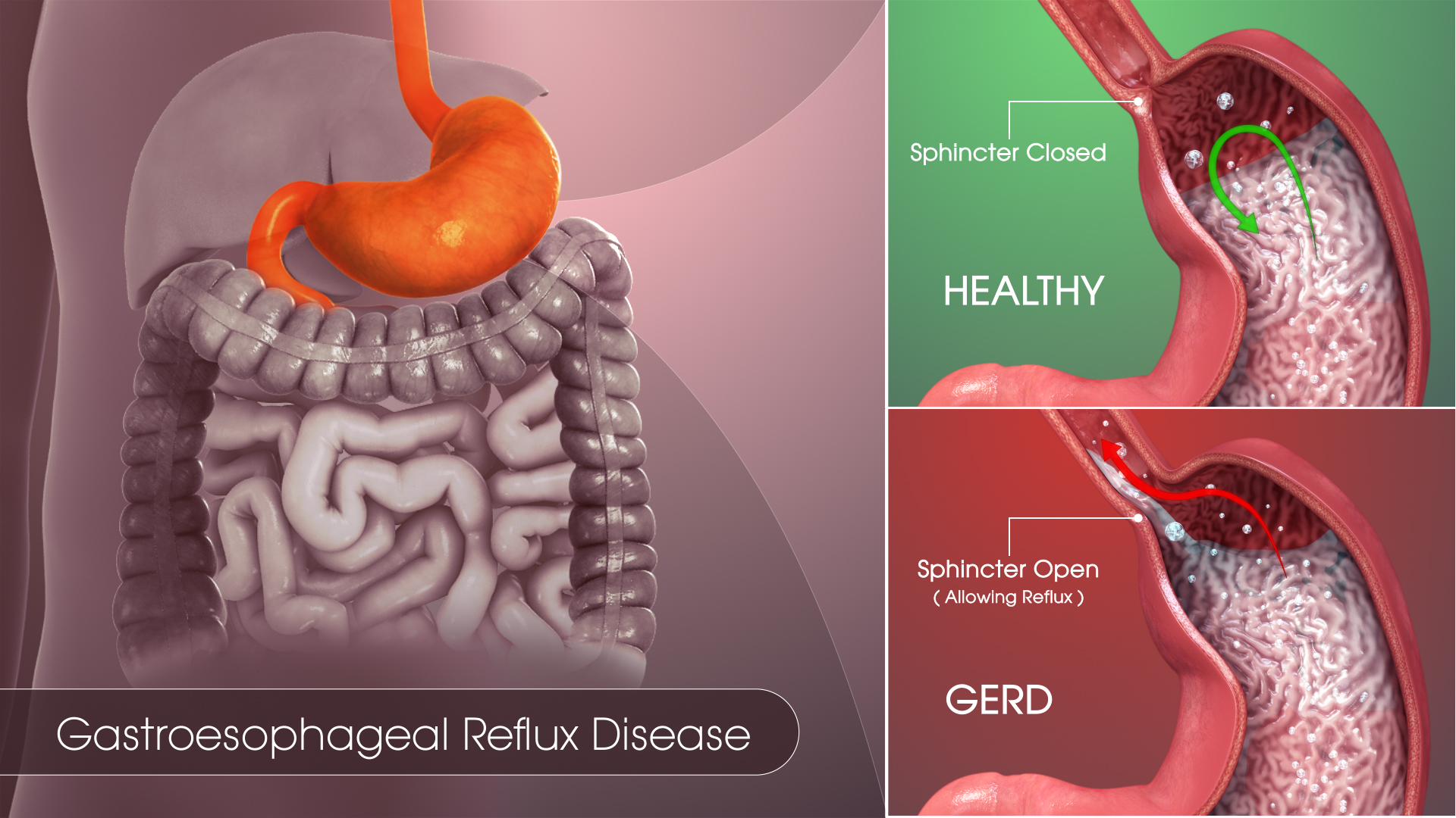 stomach acid reflux