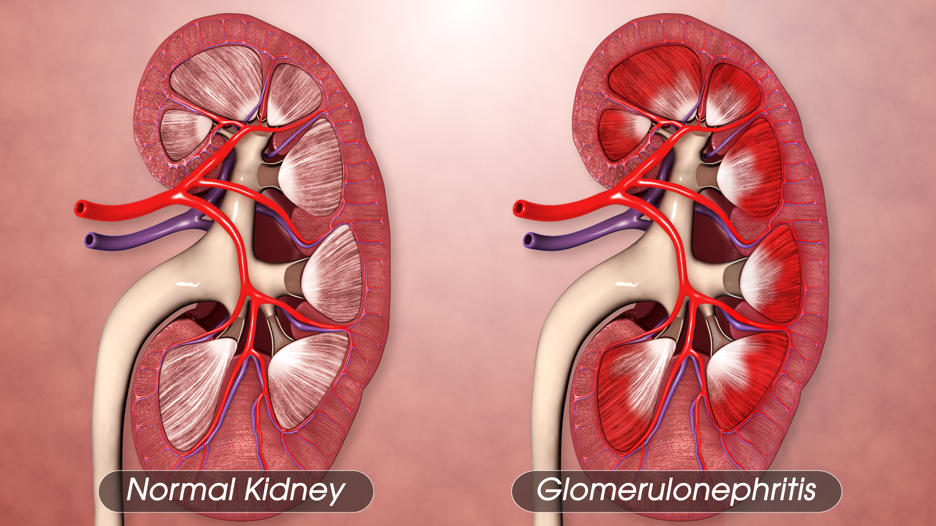 Glomerulonephritis: Symptoms, Causes, and Treatment - Scientific Animations