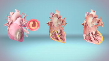 Medical animation still showing Comparison between Heart Attack, Cardiac Arrest and Heart Failure.