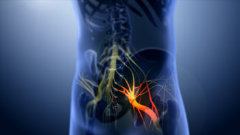 3D Medical Animation Still Depicting Sciatica