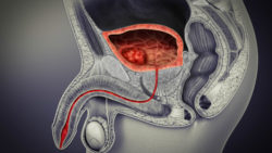 3D medical animation still showing Bladder Cancer.