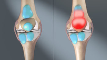 Medical animation still showing Bursitis.