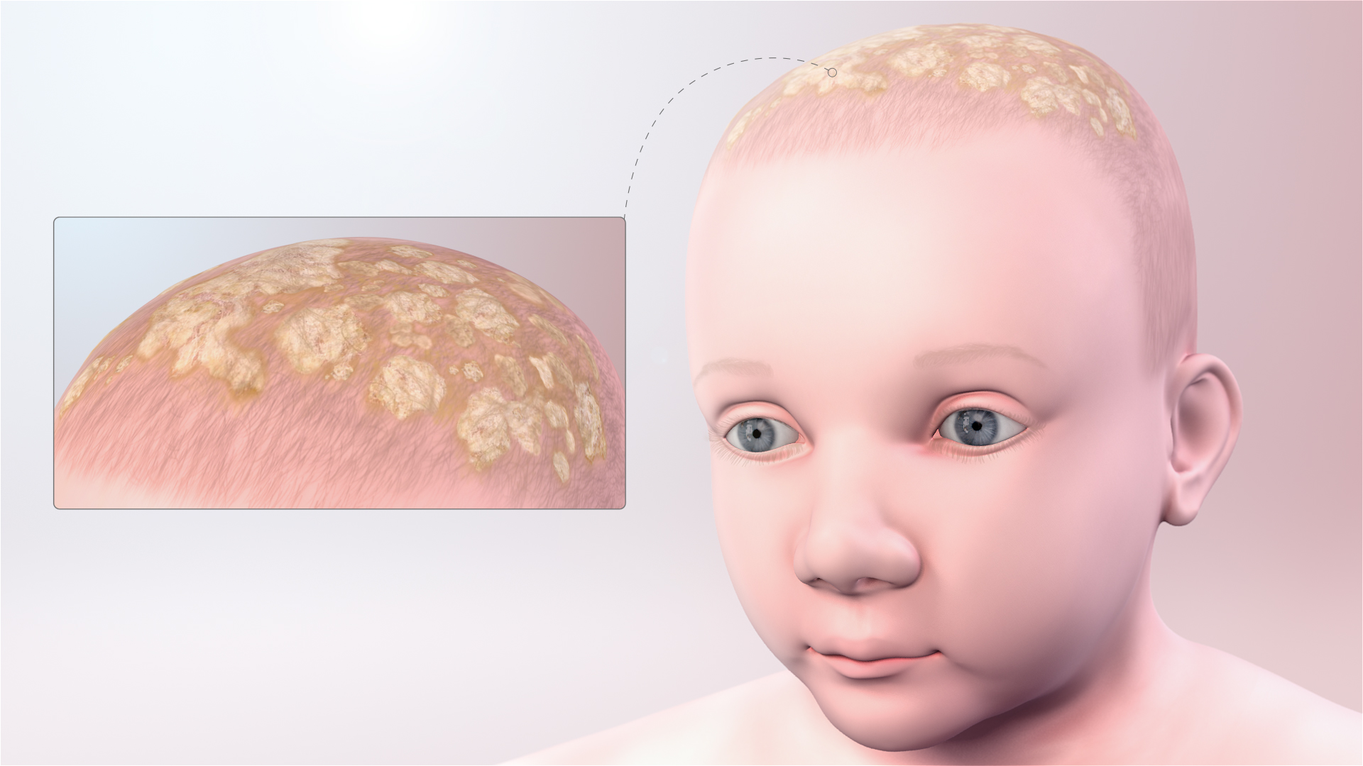 cradle cap cures infant