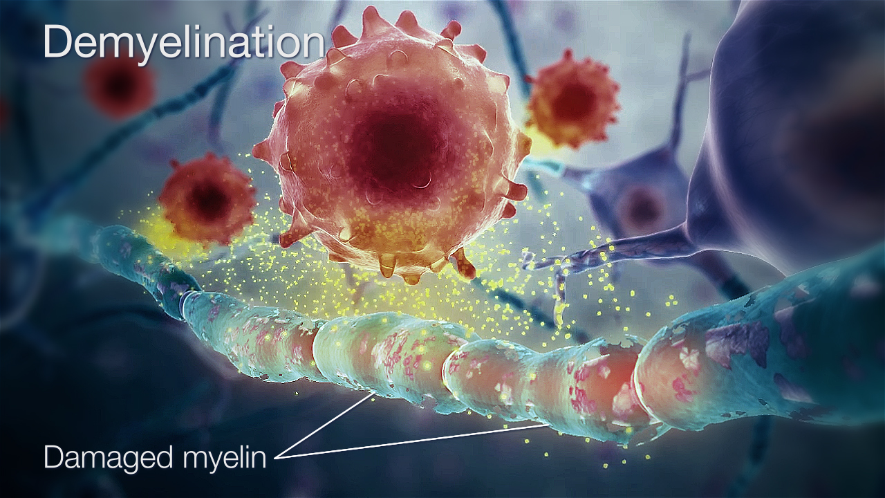 research paper demyelinating disease