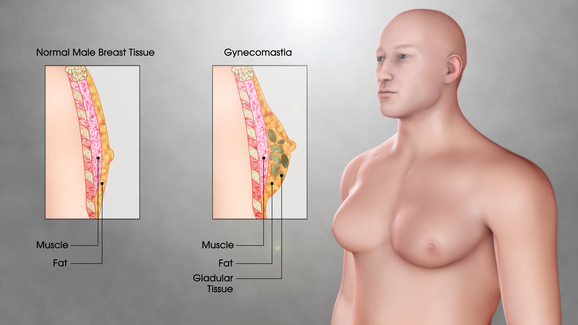 Gynecomastia (Gynaecomastia): Symptoms, Causes, and Treatment - Scientific  Animations