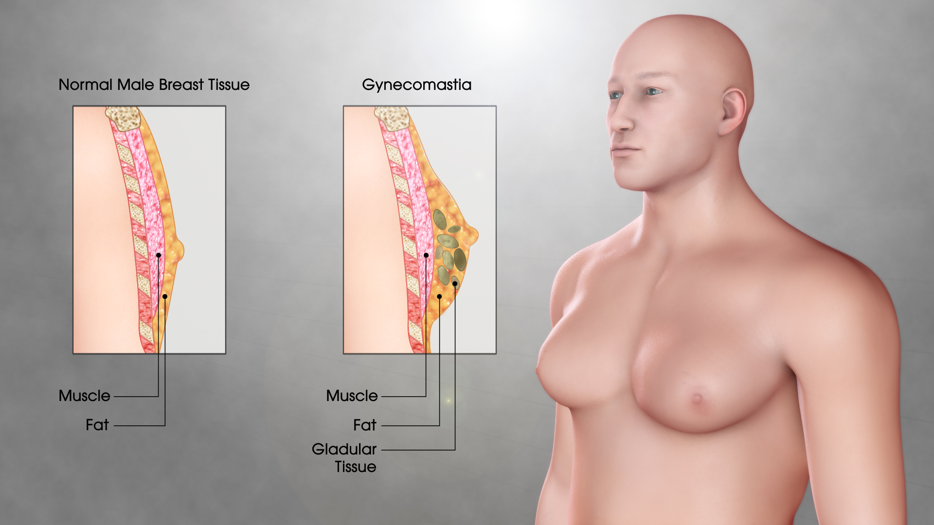 Gynecomastia (Gynaecomastia): Symptoms, Causes, and Treatment - Scientific Animations Gynecomastia (Gynaecomastia): Symptoms, Causes, and Treatment - Scientific Animations