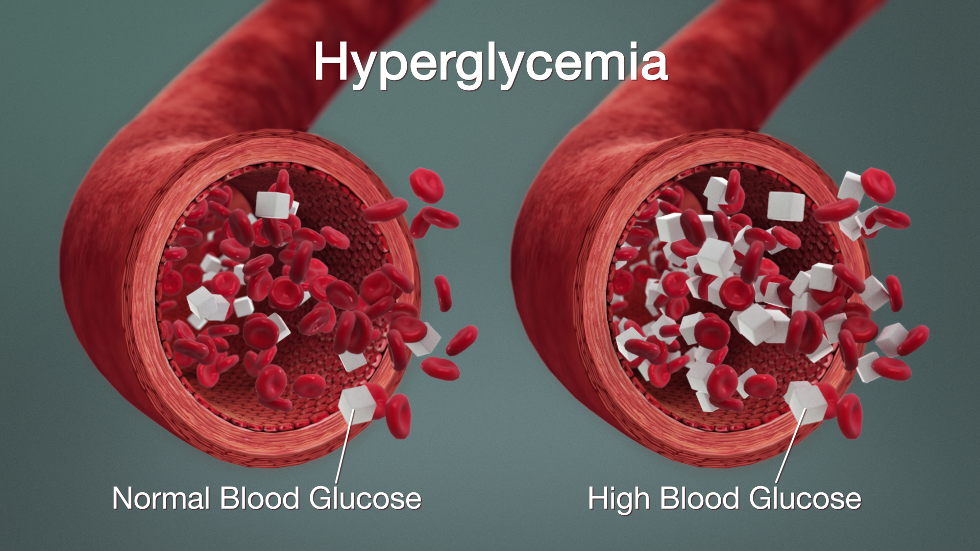 3D medical animation still showing difference between Normal and High Blood Glucose