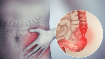 3D medical animation still showing Irritable bowel syndrome.