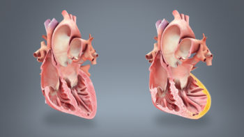 Medical animation still showing normal heart vs heart faliure.
