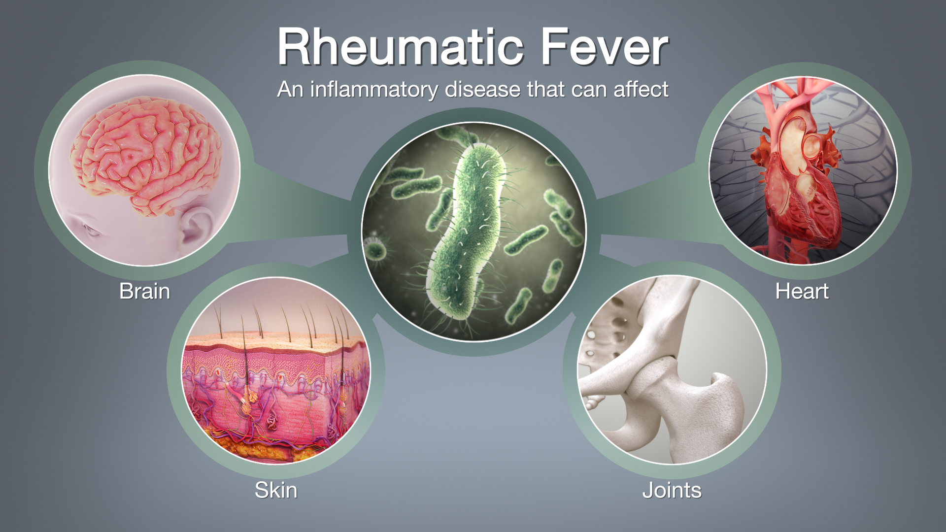 Rheumatic Fever: Symptoms, Causes, and Treatment - Scientific Animations