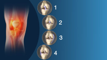 Medical Animation Still Showing Knee Sprain.