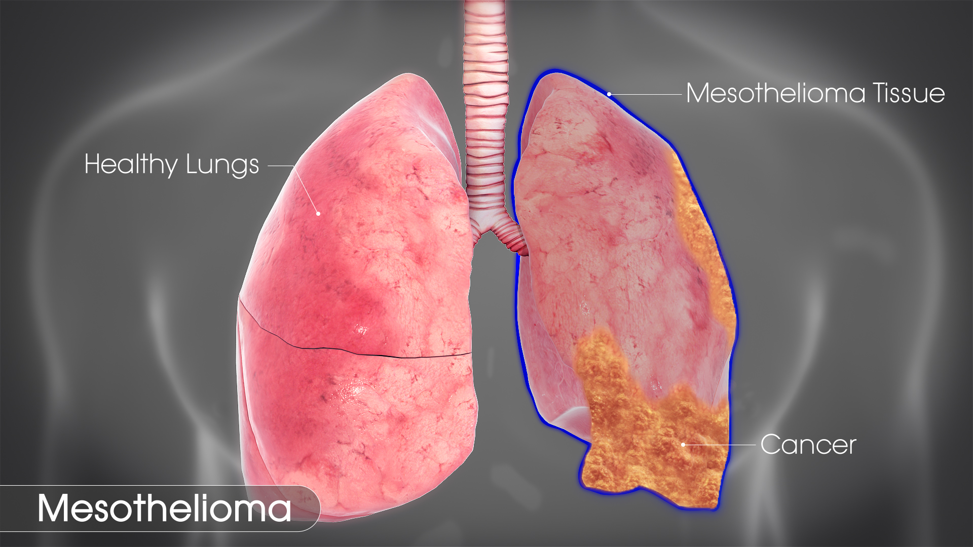 mesothelioma bmj best practice