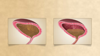 Medical Animation Still Showing urinary incontinence.