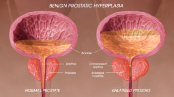 3D Medical Animation Still Depicting Prostatic Hyperplasia