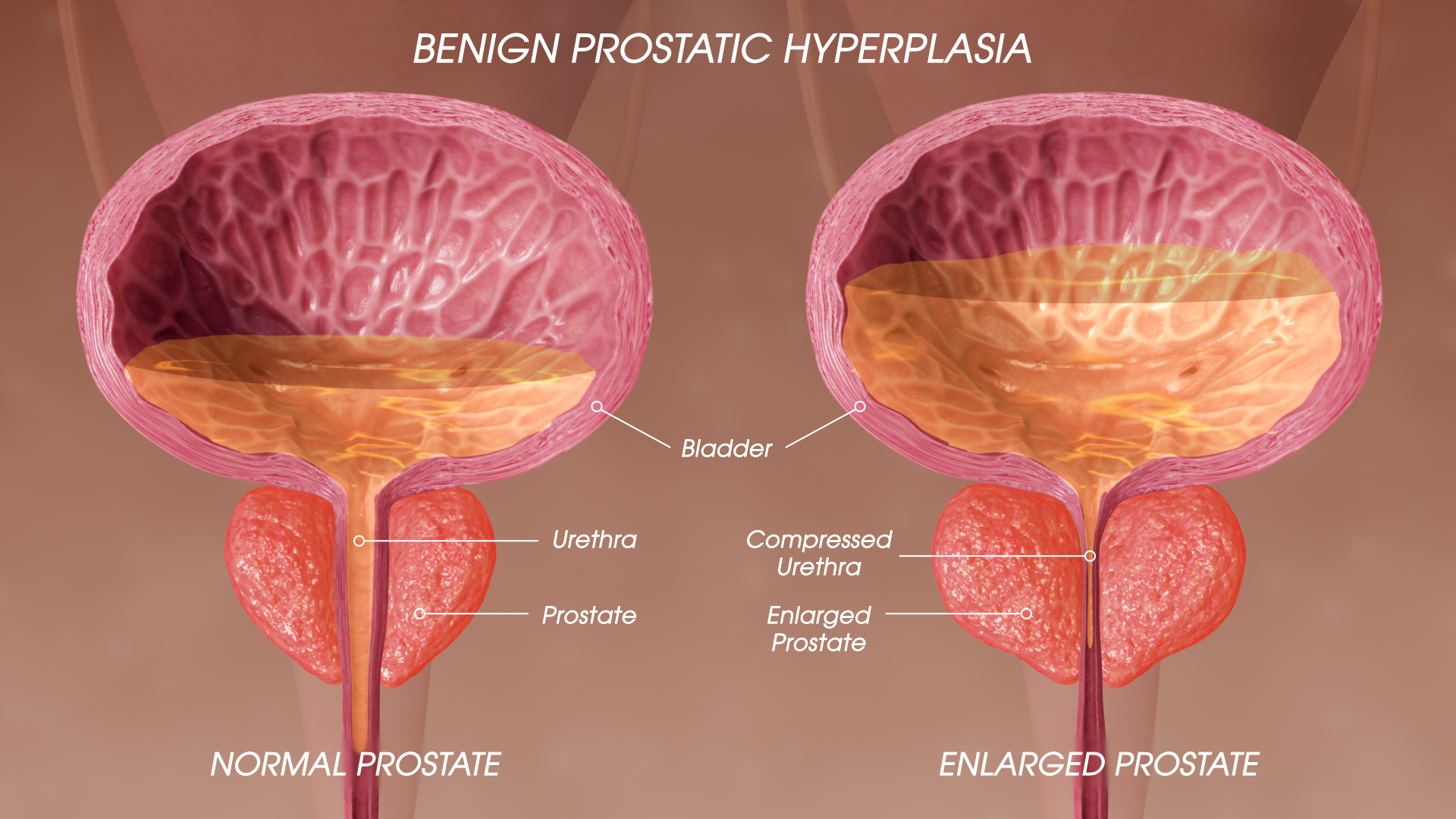 Prostatitis hiperplázia