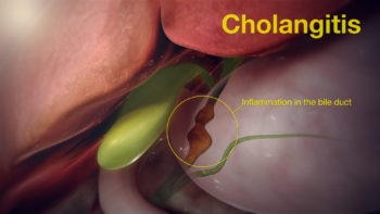 3D Medical Animation Still Depicting Cholangitis