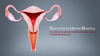 3D Medical Animation Still Depicting Dysfunctional Uterine Bleed