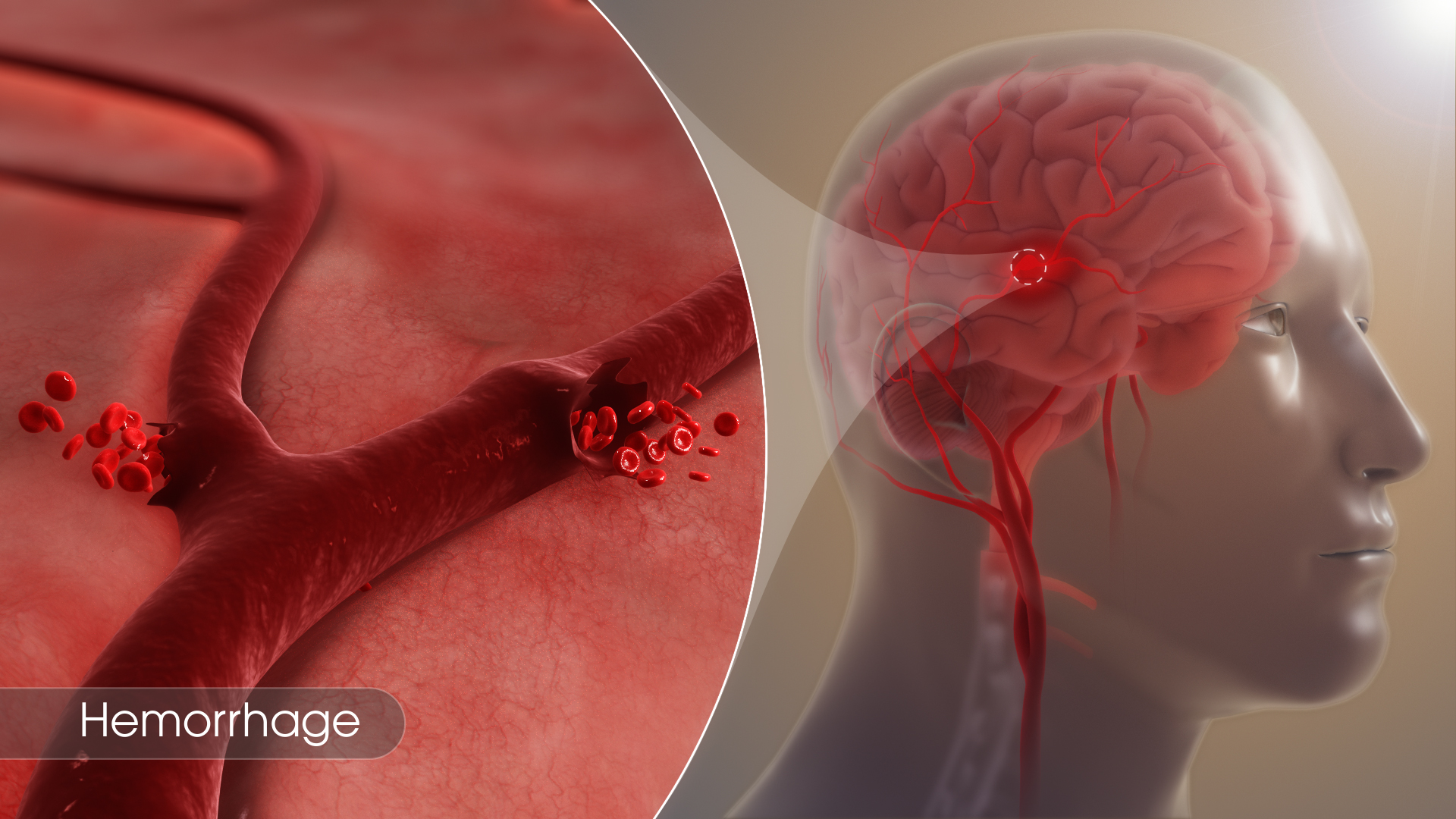 SAG_Hemorrhage_190503_01.jpg