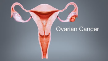 3D Medical Animation Still Depicting Ovarian Cancer