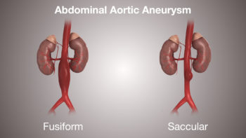 3D Medical Animation still showing Abdominal Aortic Aneurysm